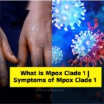 Symptoms of Mpox Clade 1